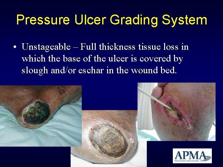 Pressure Ulcer Grading System • Unstageable – Full thickness tissue loss in which the Pressure Ulcer Grading System • Unstageable – Full thickness tissue loss in which the