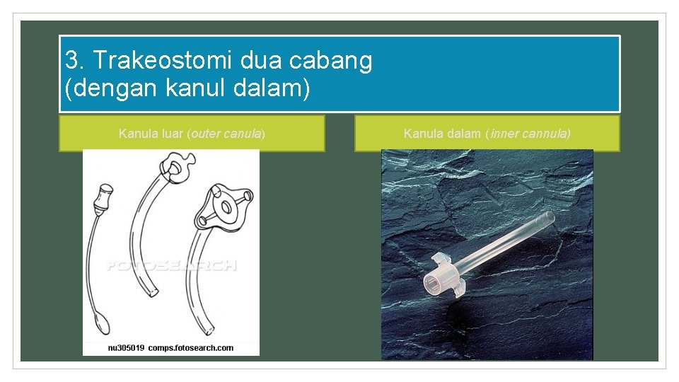 3. Trakeostomi dua cabang (dengan kanul dalam) Kanula luar (outer canula) Kanula dalam (inner