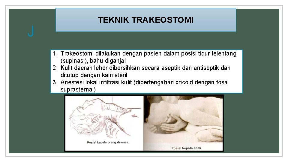 J TEKNIK TRAKEOSTOMI 1. Trakeostomi dilakukan dengan pasien dalam posisi tidur telentang (supinasi), bahu J TEKNIK TRAKEOSTOMI 1. Trakeostomi dilakukan dengan pasien dalam posisi tidur telentang (supinasi), bahu
