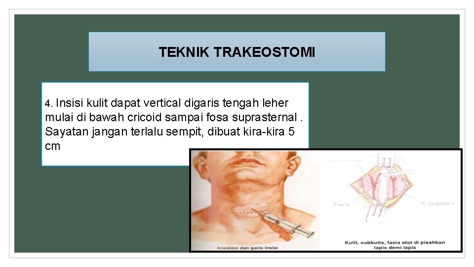 TEKNIK TRAKEOSTOMI 4. Insisi kulit dapat vertical digaris tengah leher mulai di bawah cricoid