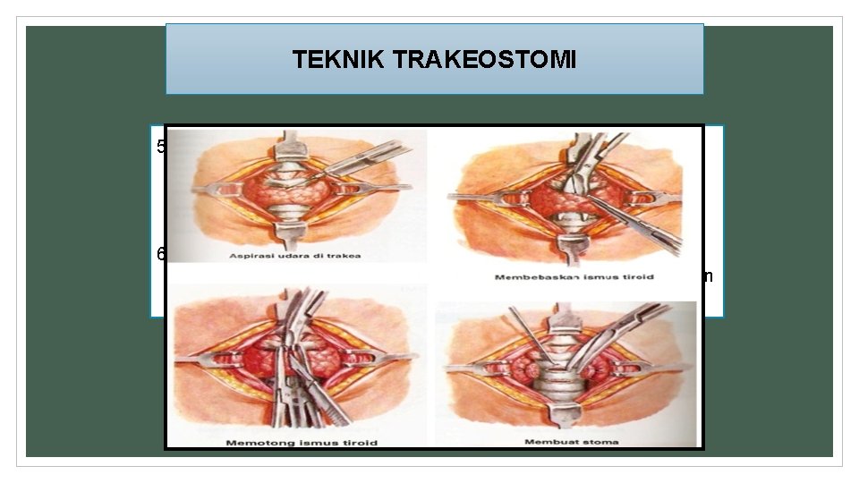 TEKNIK TRAKEOSTOMI 5. Dengan gunting panjang tumpul kulit serta jaringan di bawahnya dipisahkan lapis