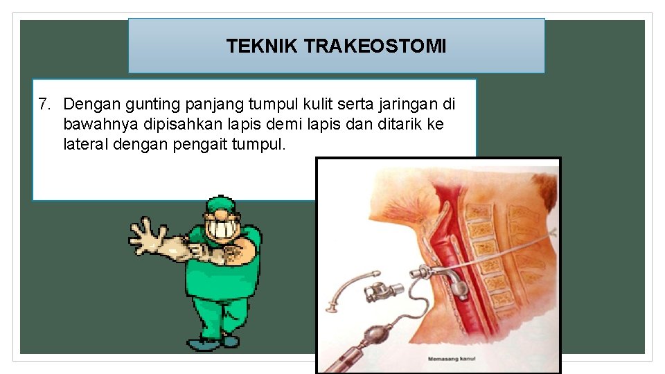 TEKNIK TRAKEOSTOMI 7. Dengan gunting panjang tumpul kulit serta jaringan di bawahnya dipisahkan lapis