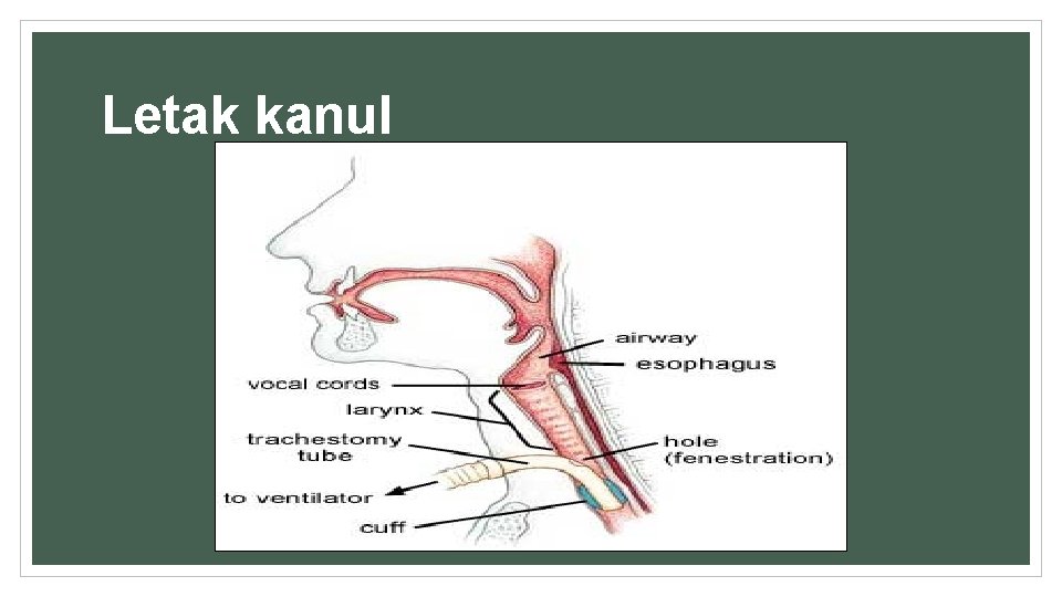 Letak kanul 