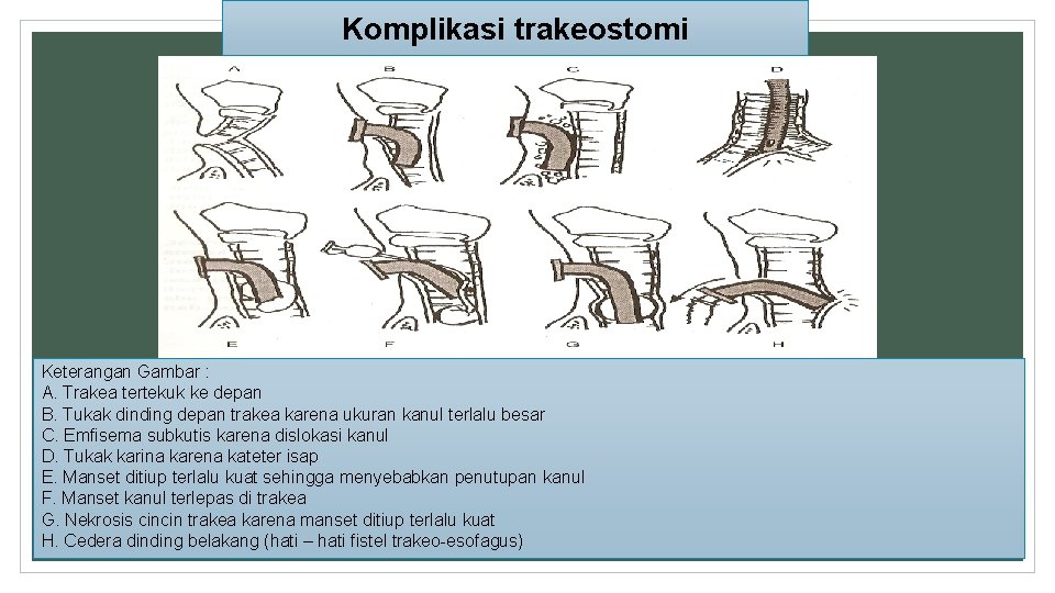 Komplikasi trakeostomi Keterangan Gambar : A. Trakea tertekuk ke depan B. Tukak dinding depan