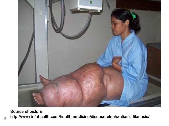 18 Source of picture: http: //www. infahealth. com/health-medicine/disease-elephantiasis-filariasis/ 