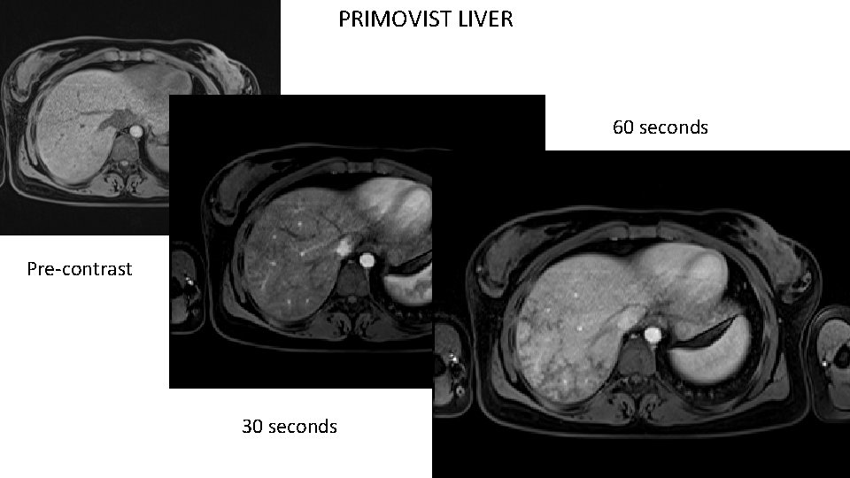 PRIMOVIST LIVER 60 seconds Pre-contrast 30 seconds 