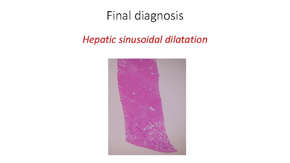 Final diagnosis Hepatic sinusoidal dilatation 