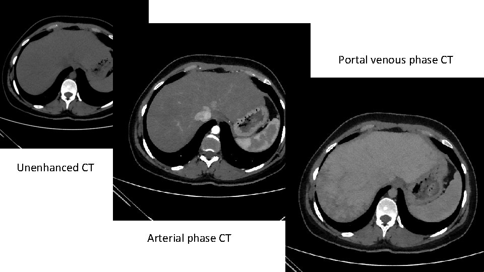 Portal venous phase CT Unenhanced CT Arterial phase CT 