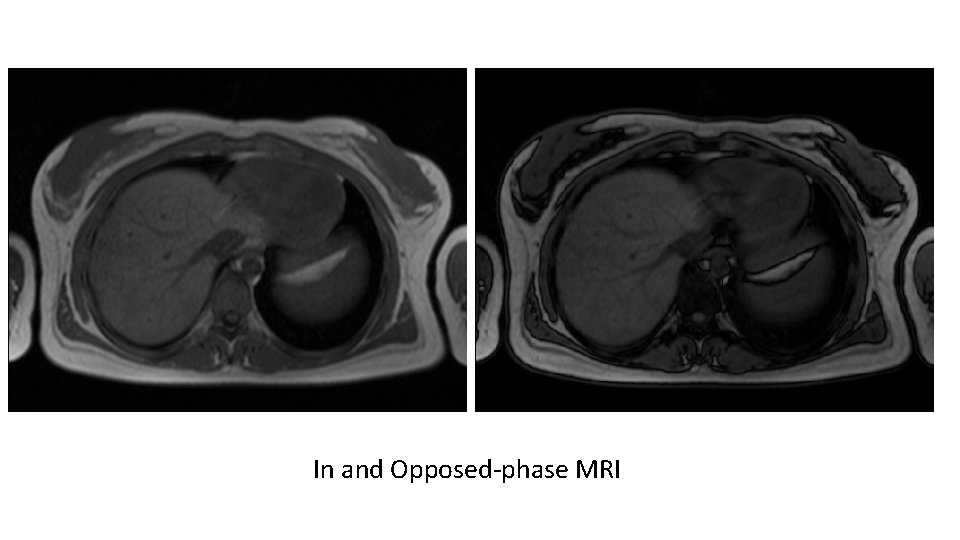 In and Opposed-phase MRI 