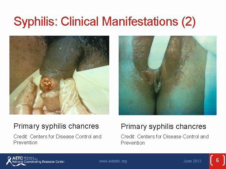 Syphilis: Clinical Manifestations (2) Primary syphilis chancres Credit: Centers for Disease Control and Prevention