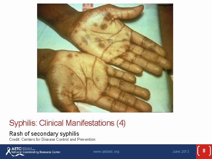 Syphilis: Clinical Manifestations (4) Rash of secondary syphilis Credit: Centers for Disease Control and