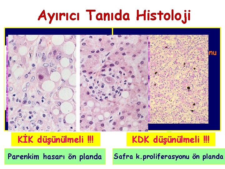 Ayırıcı Tanıda Histoloji • Lobüler düzensizlik • Dev hücreler • Hepatoselüler nekroz • Portal