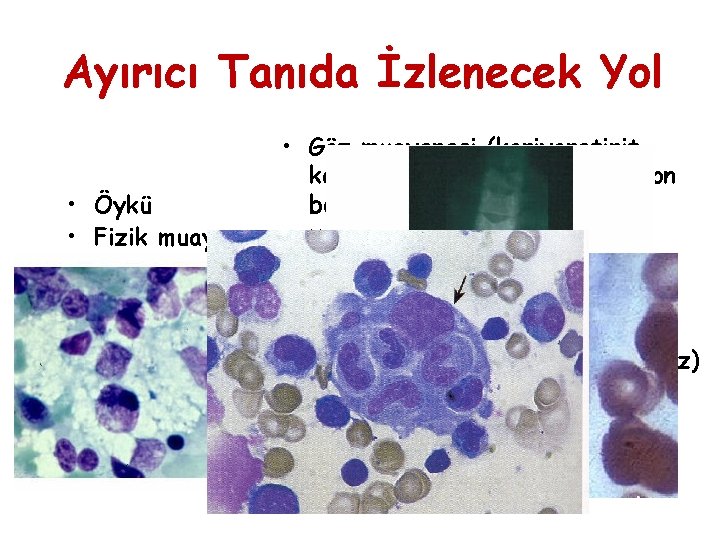 Ayırıcı Tanıda İzlenecek Yol • Göz muayenesi (koriyoretinit, katarakt, embriyotokson, japon bayrağı) • Öykü