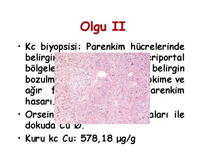 Olgu II • Kc biyopsisi: Parenkim hücrelerinde belirgin şişme, özellikle periportal bölgelerde kordon düzeninde