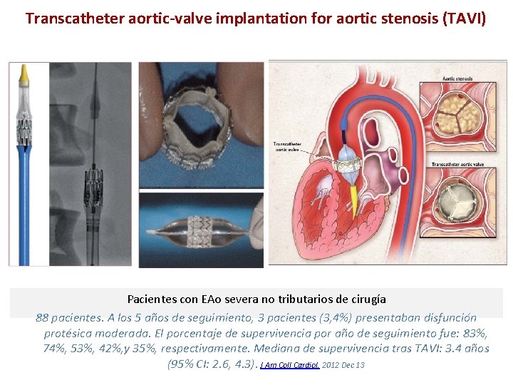 Transcatheter aortic-valve implantation for aortic stenosis (TAVI) Pacientes con EAo severa no tributarios de