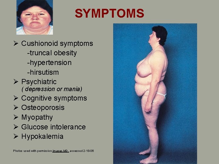 SYMPTOMS Ø Cushionoid symptoms -truncal obesity -hypertension -hirsutism Ø Psychiatric ( depression or mania) SYMPTOMS Ø Cushionoid symptoms -truncal obesity -hypertension -hirsutism Ø Psychiatric ( depression or mania)