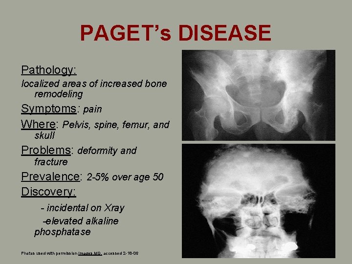 PAGET’s DISEASE Pathology: localized areas of increased bone remodeling Symptoms: pain Where: Pelvis, spine, PAGET’s DISEASE Pathology: localized areas of increased bone remodeling Symptoms: pain Where: Pelvis, spine,