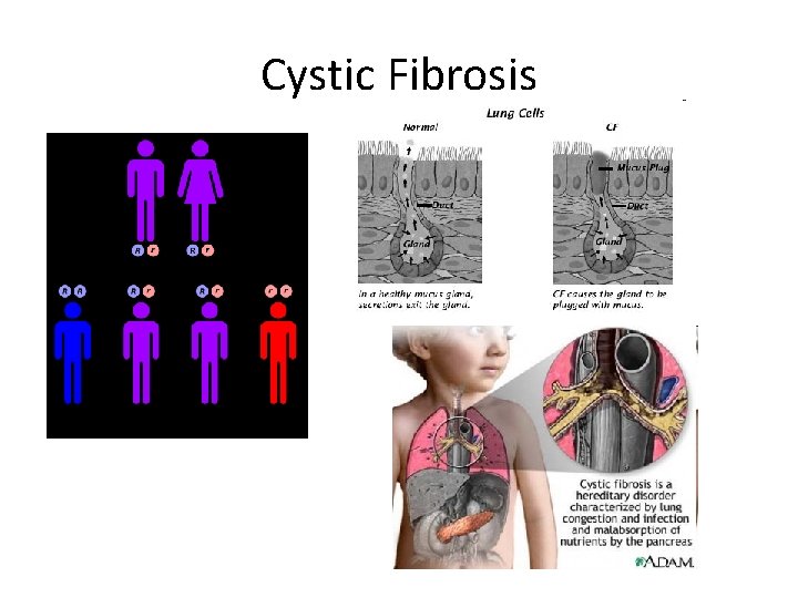 Cystic Fibrosis 