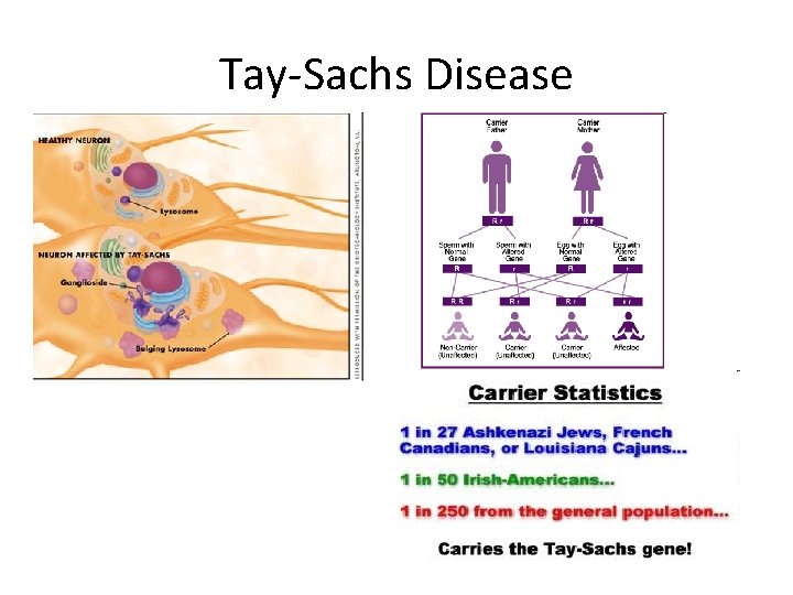 Tay-Sachs Disease 