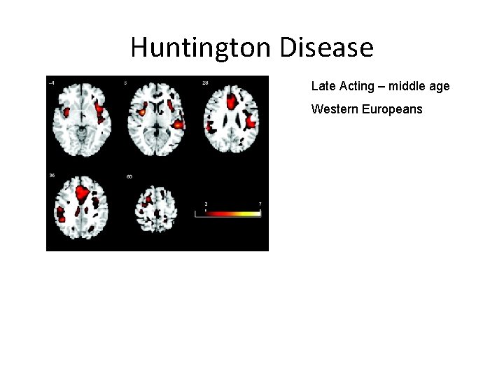 Huntington Disease Late Acting – middle age Western Europeans 