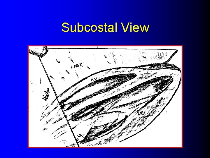 Subcostal View 