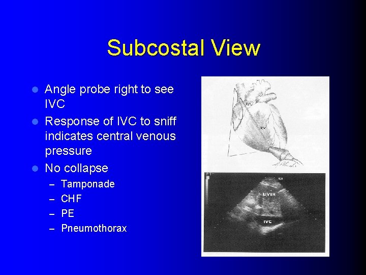 Subcostal View Angle probe right to see IVC l Response of IVC to sniff