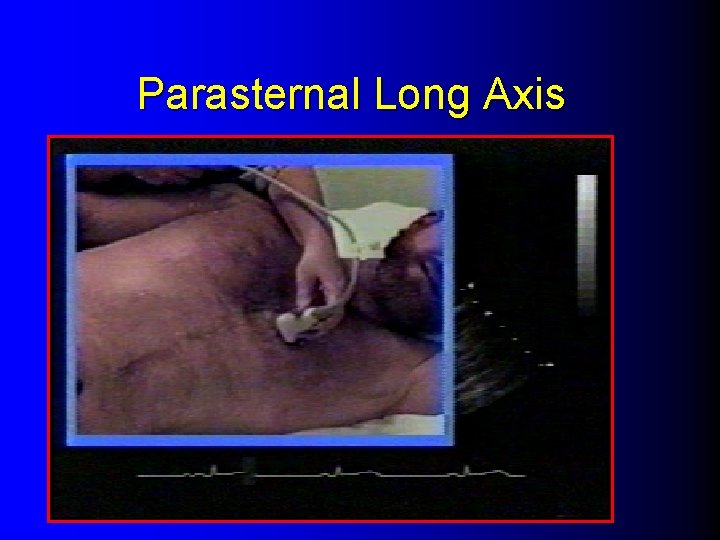 Parasternal Long Axis 