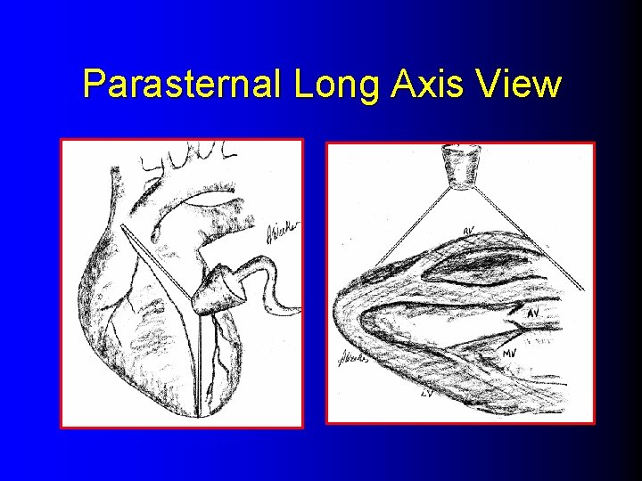 Parasternal Long Axis View 