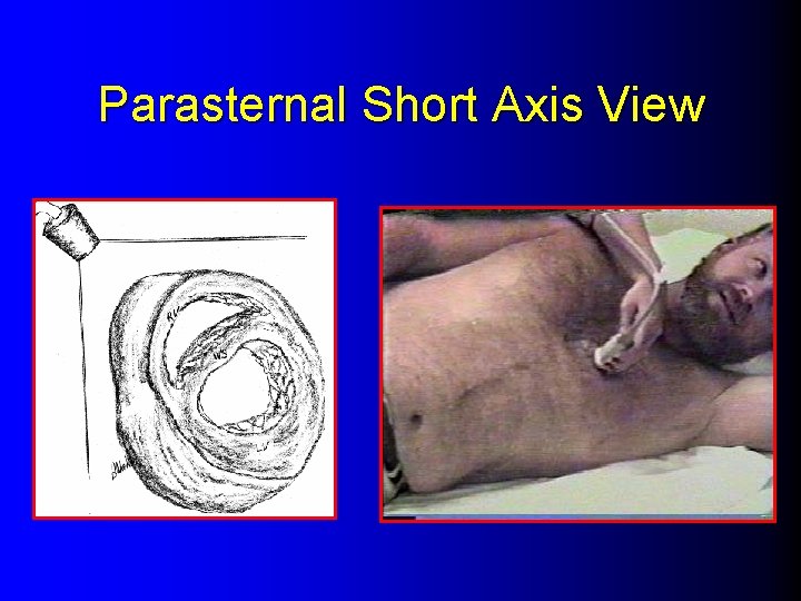 Parasternal Short Axis View 