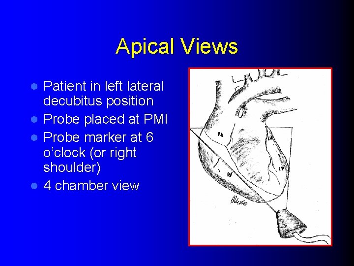 Apical Views Patient in left lateral decubitus position l Probe placed at PMI l