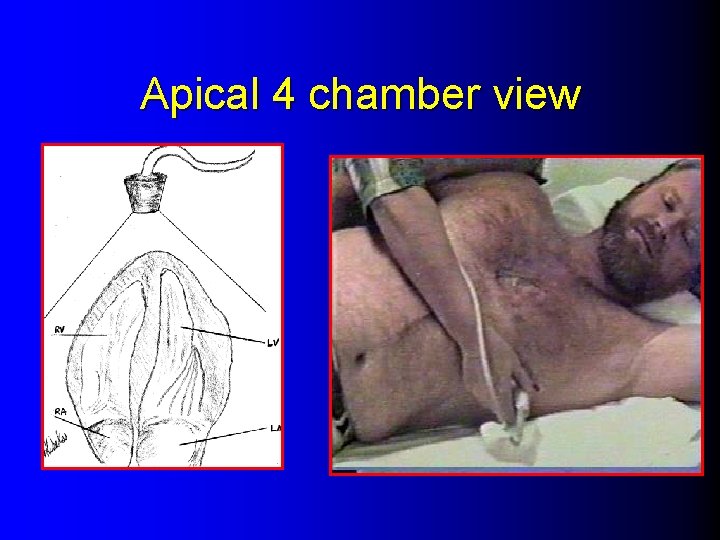 Apical 4 chamber view 