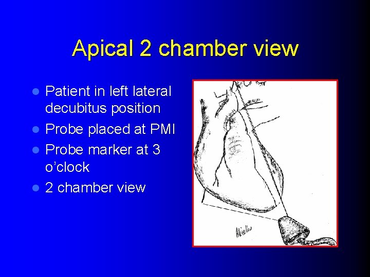Apical 2 chamber view Patient in left lateral decubitus position l Probe placed at