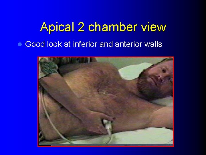 Apical 2 chamber view l Good look at inferior and anterior walls 