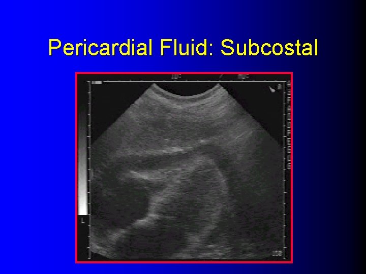 Pericardial Fluid: Subcostal 