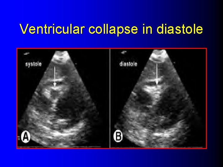 Ventricular collapse in diastole 