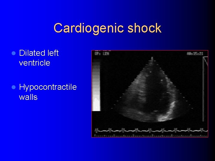 Cardiogenic shock l Dilated left ventricle l Hypocontractile walls 