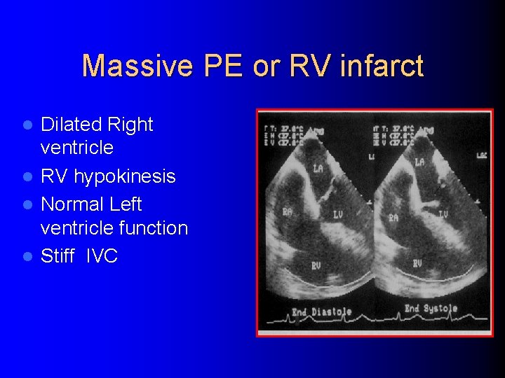 Massive PE or RV infarct Dilated Right ventricle l RV hypokinesis l Normal Left