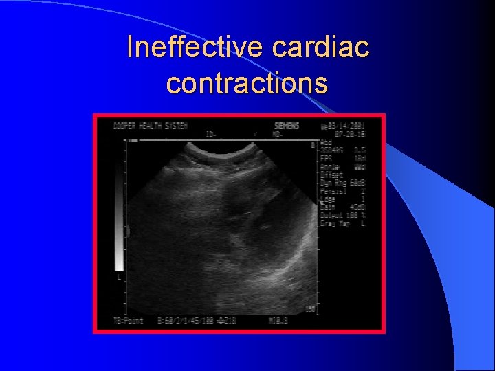 Ineffective cardiac contractions 