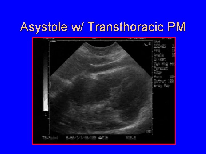 Asystole w/ Transthoracic PM 