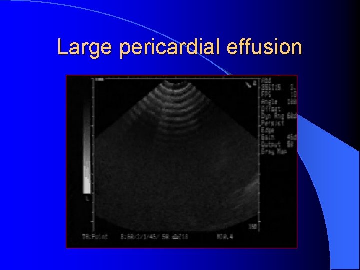 Large pericardial effusion 