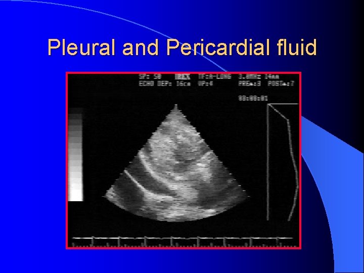 Pleural and Pericardial fluid 