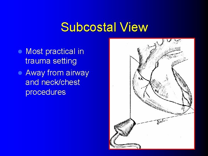 Subcostal View Most practical in trauma setting l Away from airway and neck/chest procedures