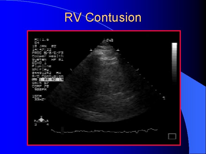 RV Contusion 