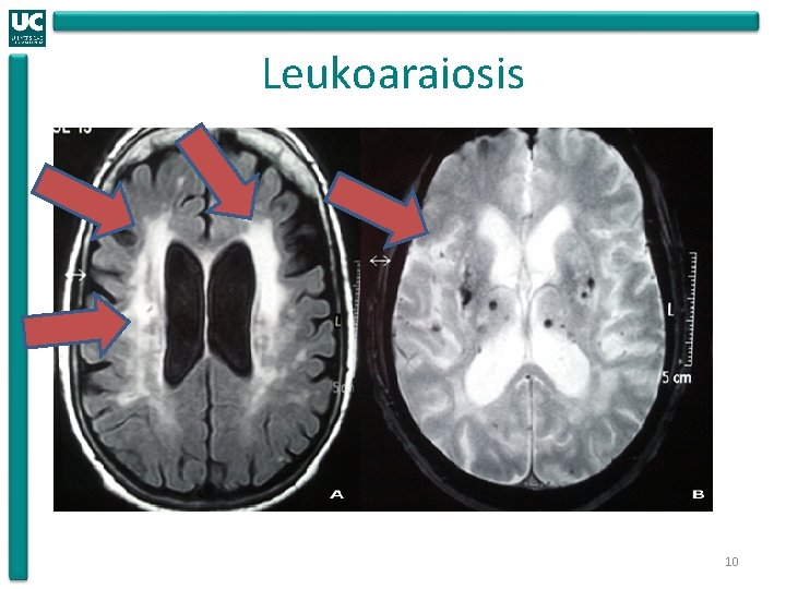 Leukoaraiosis 10 