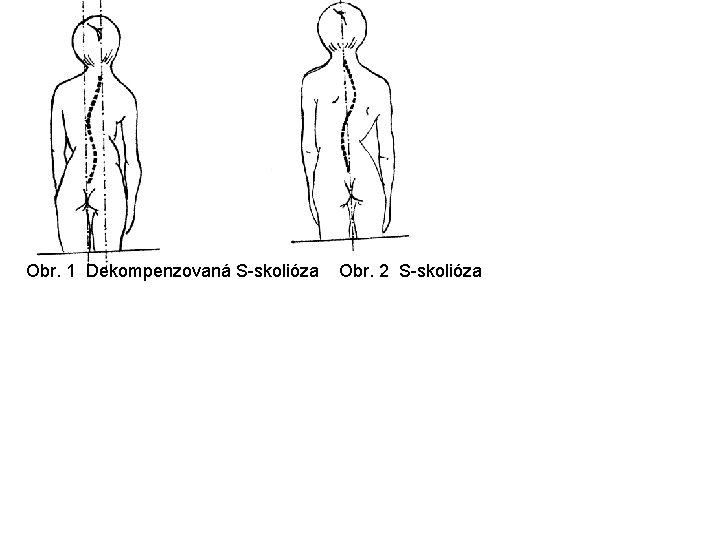  Obr. 1 Dekompenzovaná S skolióza Obr. 2 S skolióza 