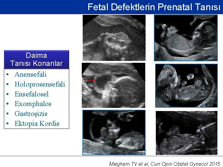 Fetal Defektlerin Prenatal Tanısı Daima Tanısı Konanlar • Anensefali • Holoprosensefali • Ensefalosel •