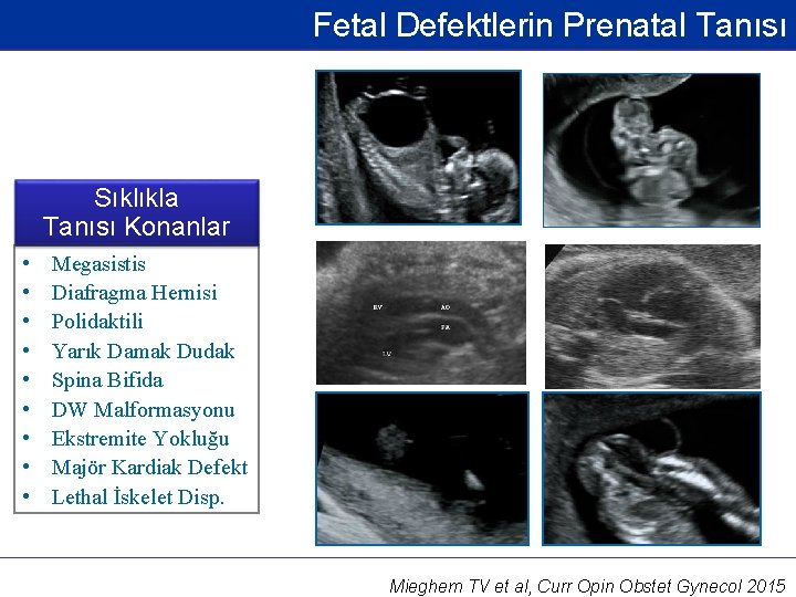 Fetal Defektlerin Prenatal Tanısı Sıklıkla Tanısı Konanlar • • • Megasistis Diafragma Hernisi Polidaktili