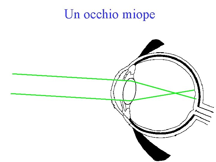 Un occhio miope 