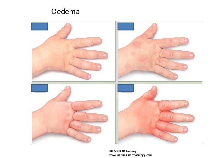 Oedema PO SCORAD training www. opened-dermatology. com 