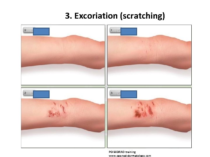 3. Excoriation (scratching) PO SCORAD training www. opened-dermatology. com 